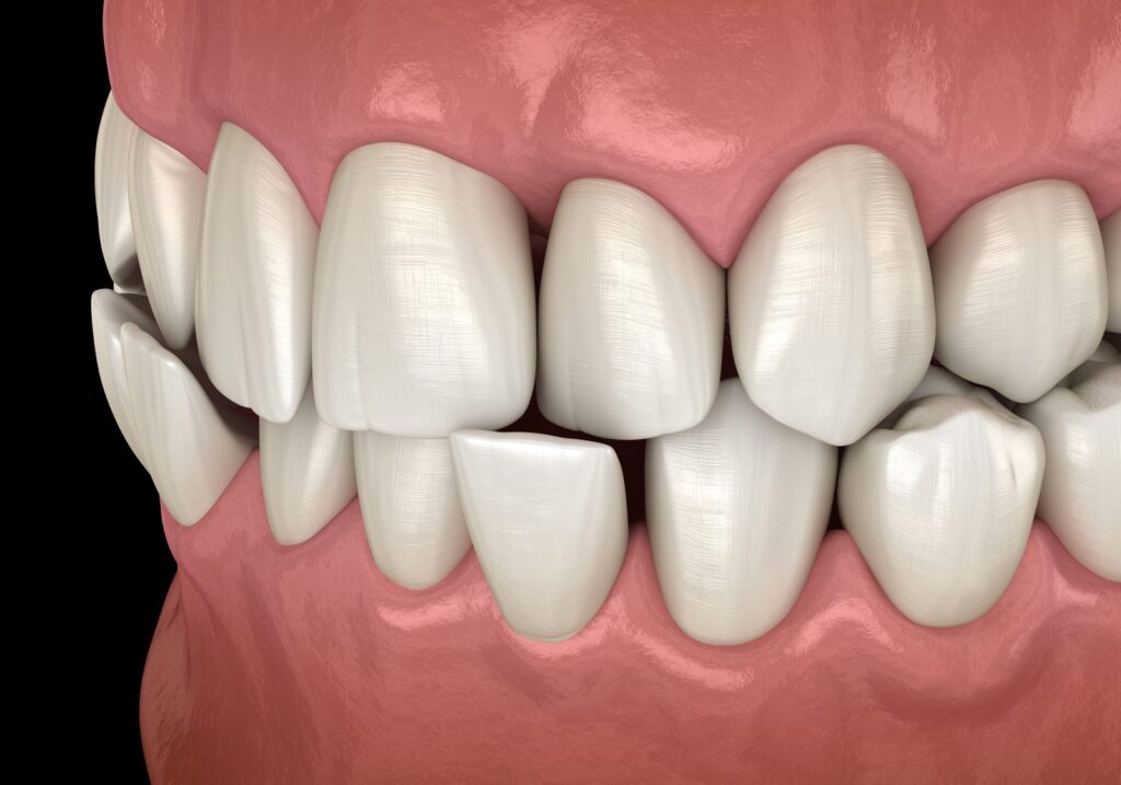 3D illustration of an anterior crossbite with the upper front teeth sitting behind the lower teeth